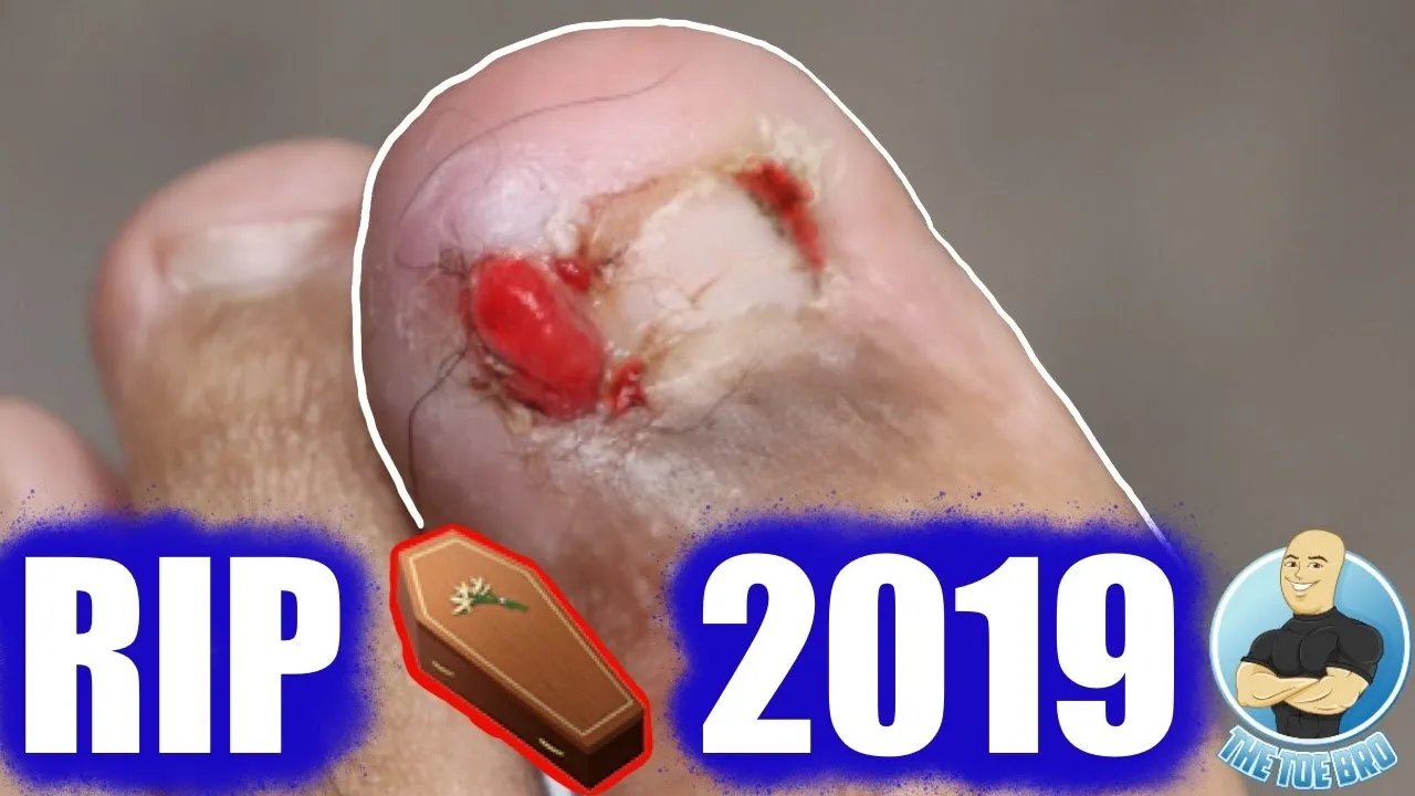 Last infected ingrown removal for this decade ***end of 2019***