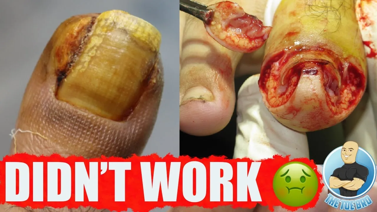 Ingrown toenail skin removal fail