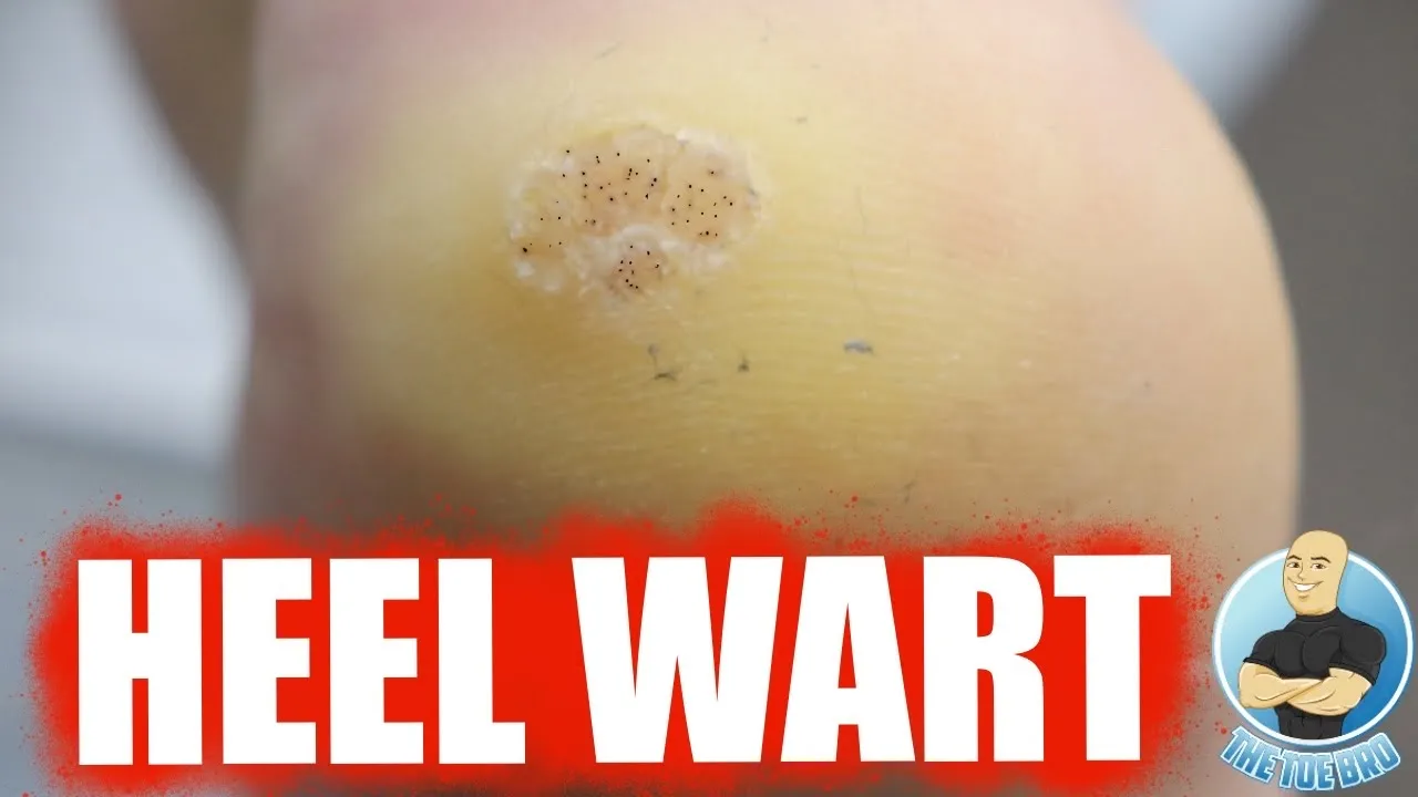 Huge heel wart being cut out!!!