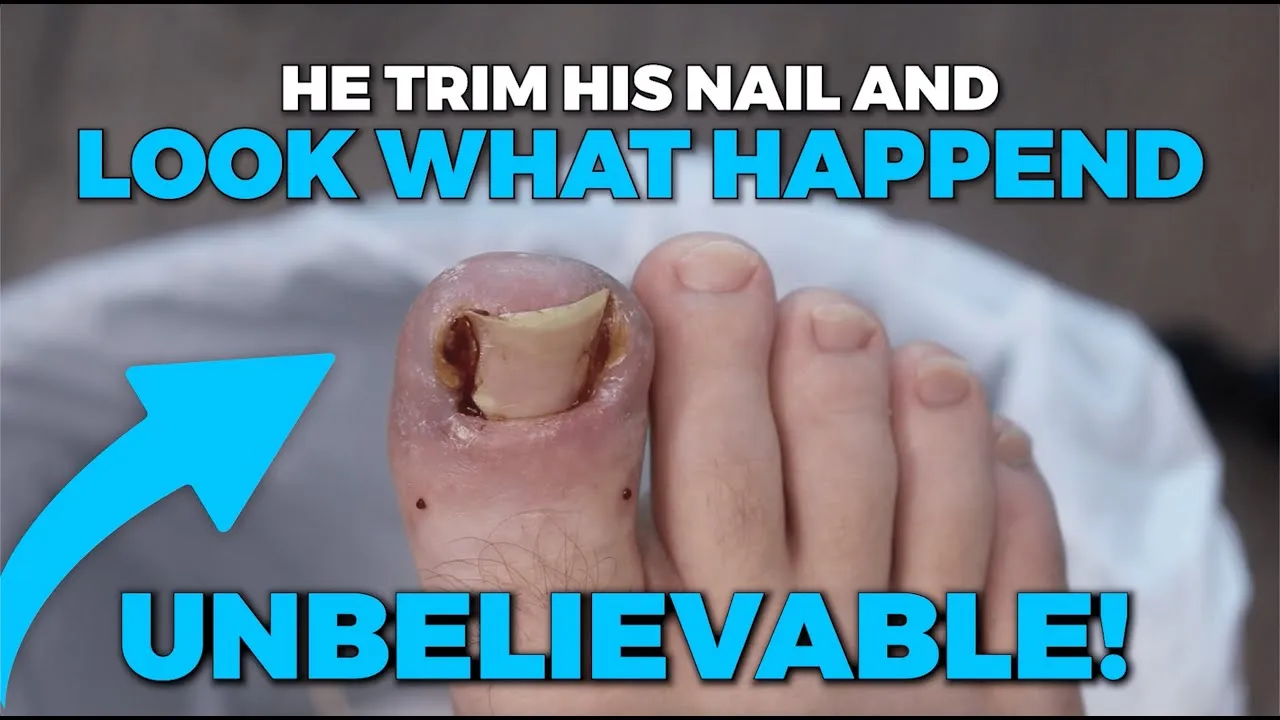 He trimmed his nail the wrong way!