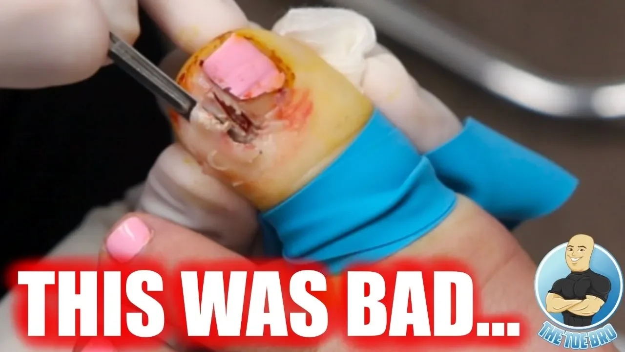 Extremely rare infected ingrown toenail