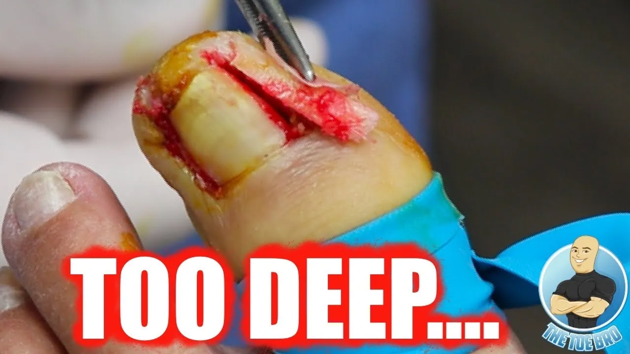 She flew 2000 miles because of her infected toenail