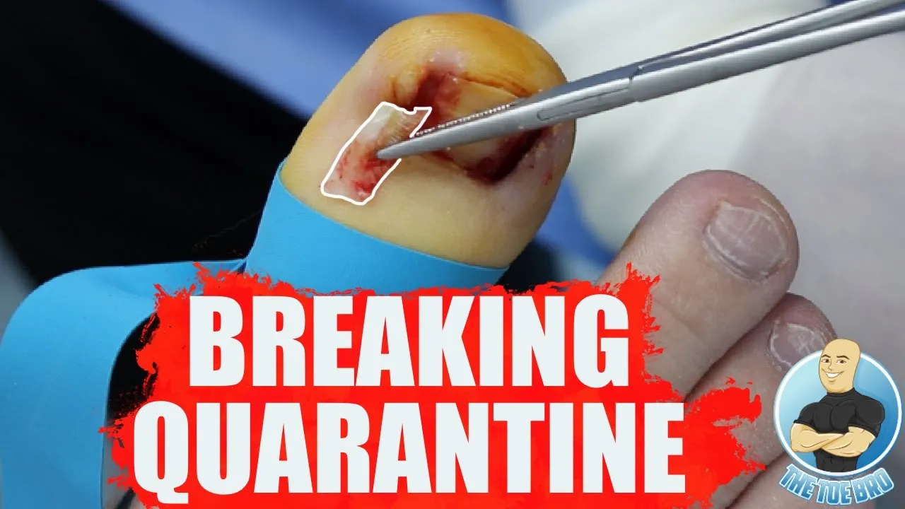 Painful ingrown toenails don’t care for covid-19!!! ***super huge nail spike***