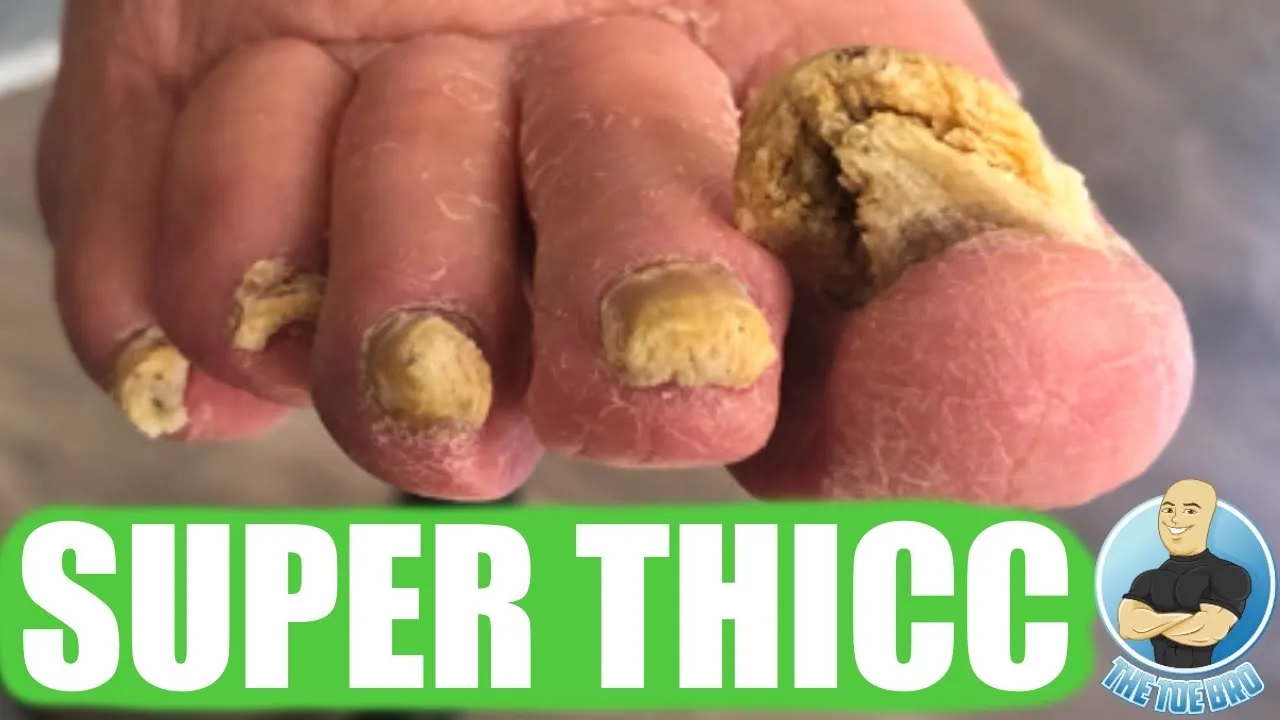 The thickest fungal toenail ever???