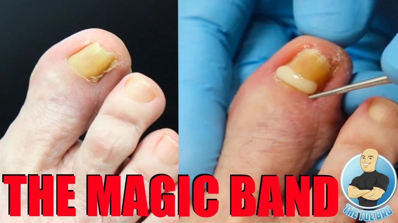 Brand new treatment for ingrown toenails ***no surgery needed***