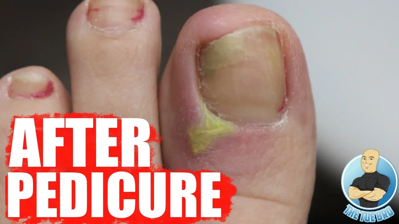She had a pedicure while in brazil ***ingrown toenail infection***