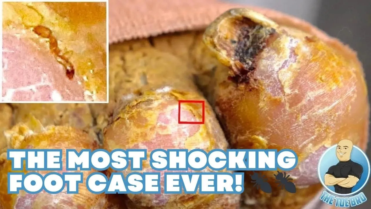 The most shocking foot you might ever see in your life ***extreme graphic warning***