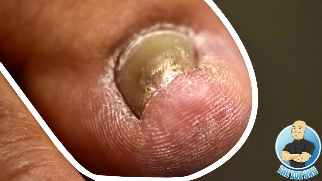 The double whammy ingrown **and** total toenail removal