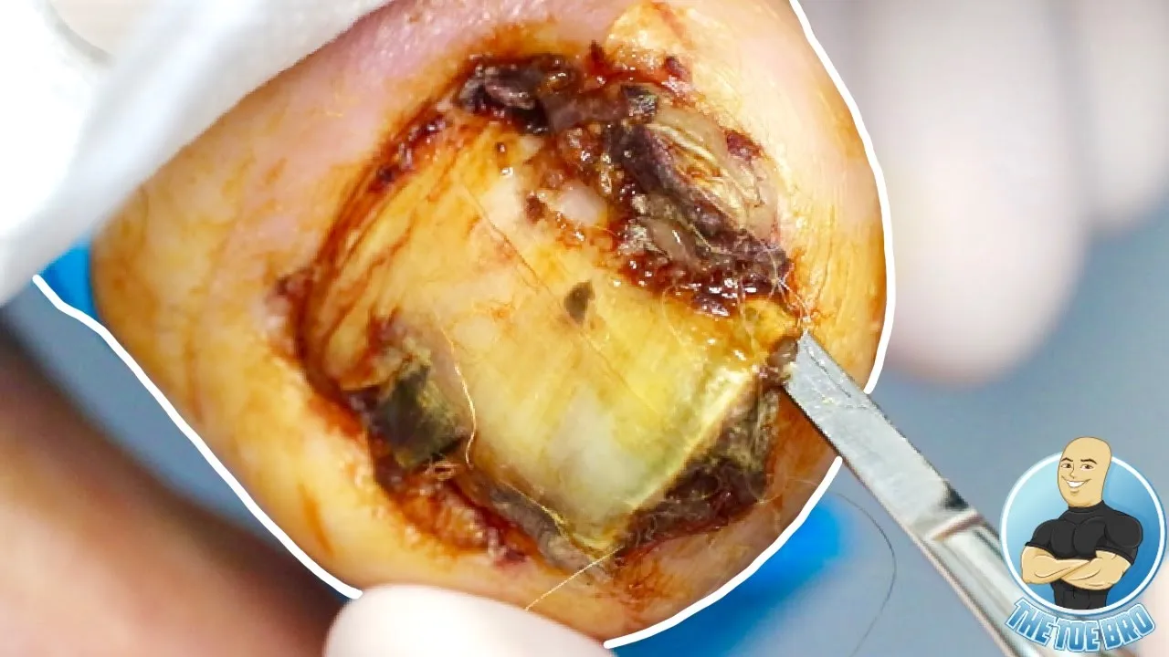 Super magnified zoom of an infected ingrown toenail removal!!!