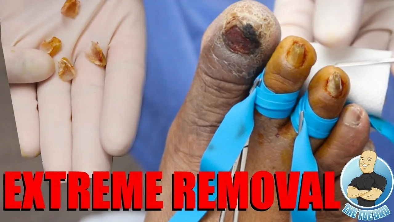 Removing 4 pincer nails at one time