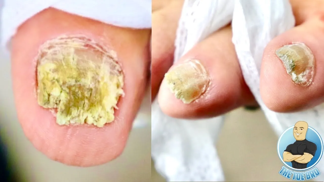 Removing 3 fungal toenails after 7 years of treatment