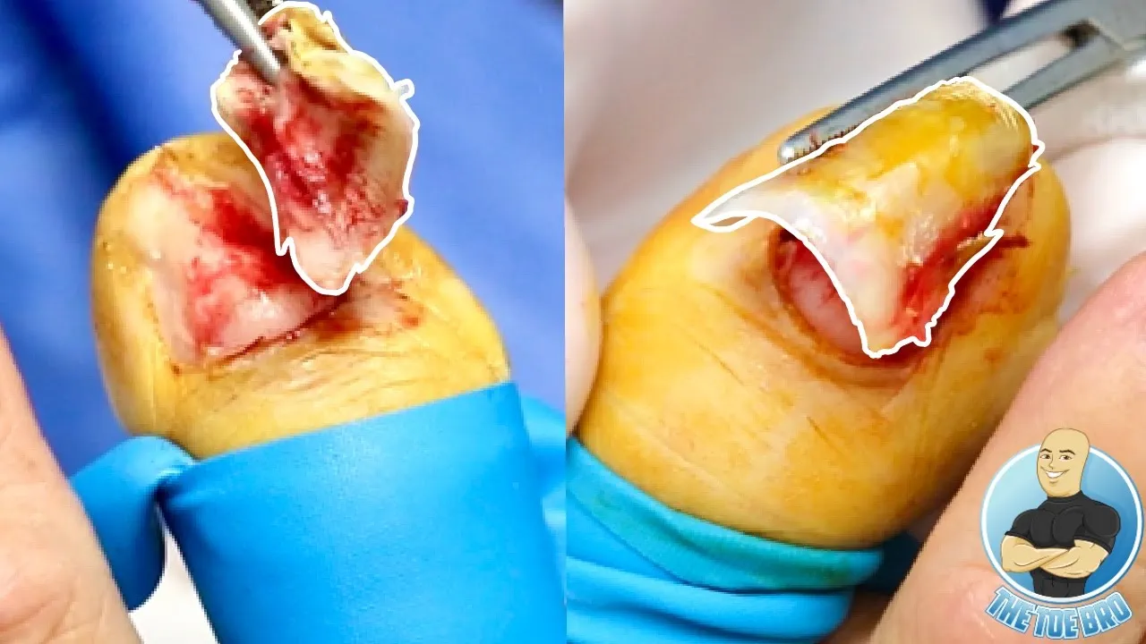Pincer toenail problems ***total nail removal forever!!!***