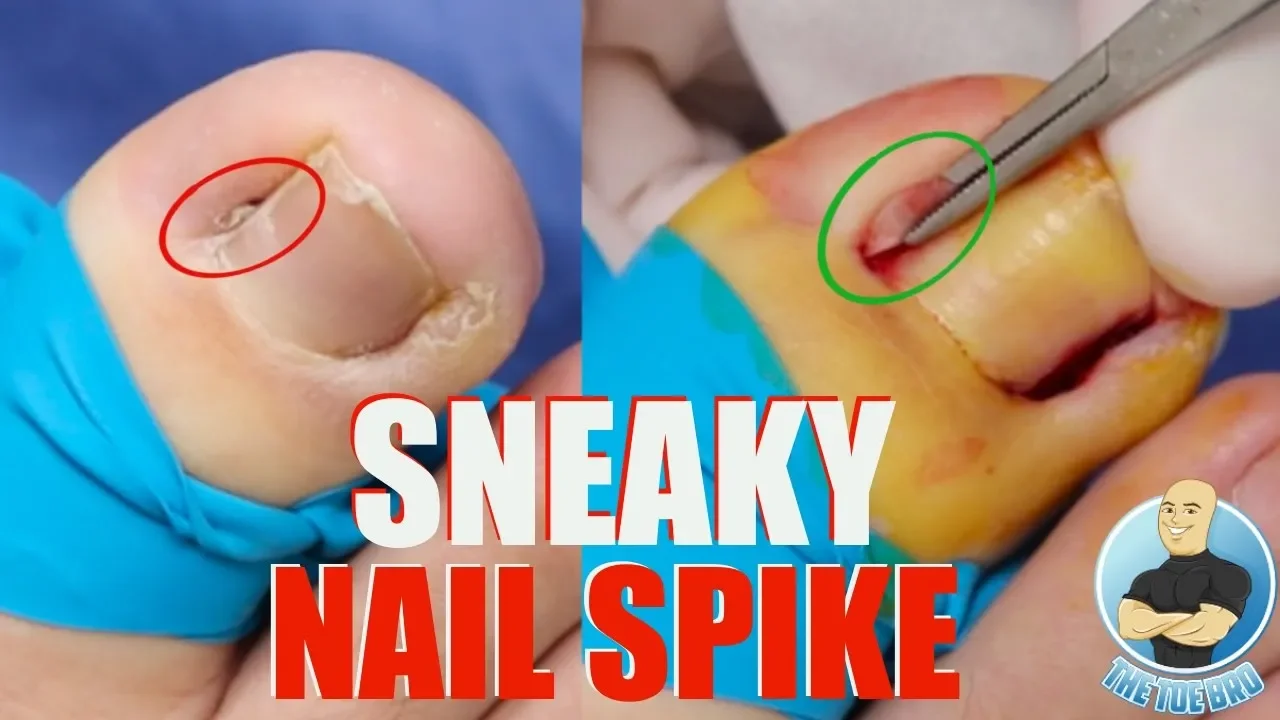 Huge nail spike after failed ingrown nail surgery