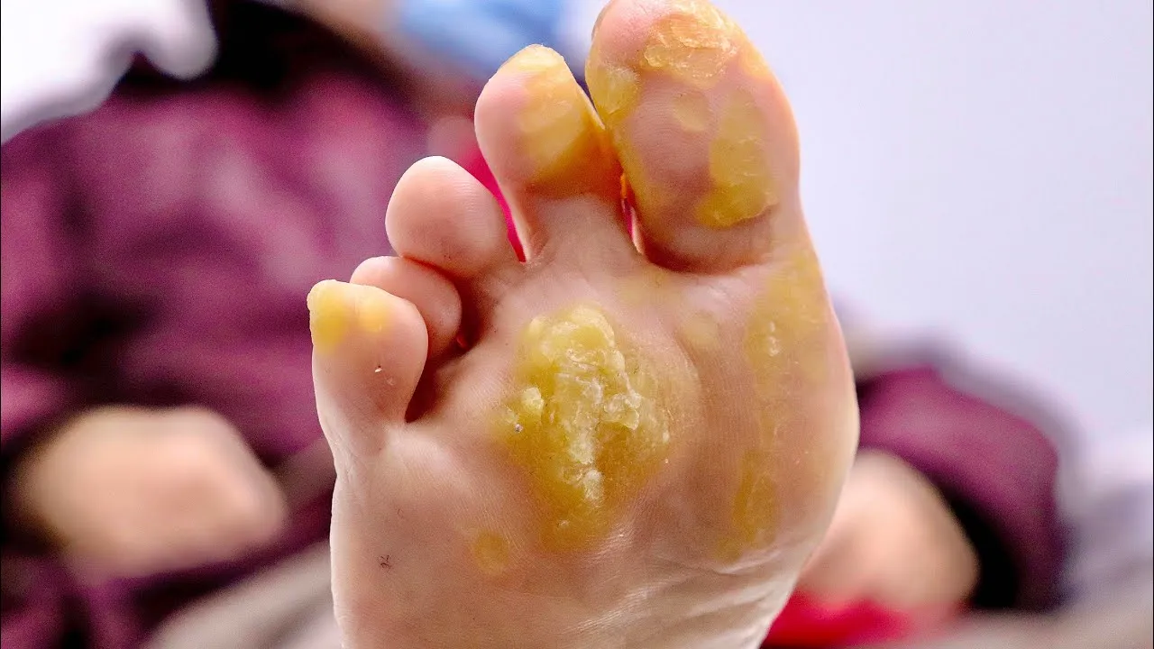 Why so much hard skin?!?!