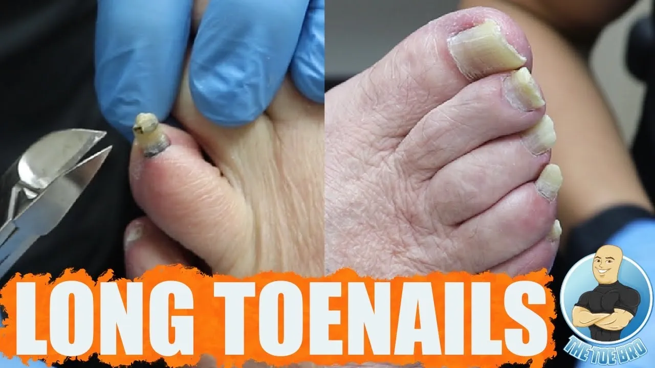 Trimming super thick and long toenails