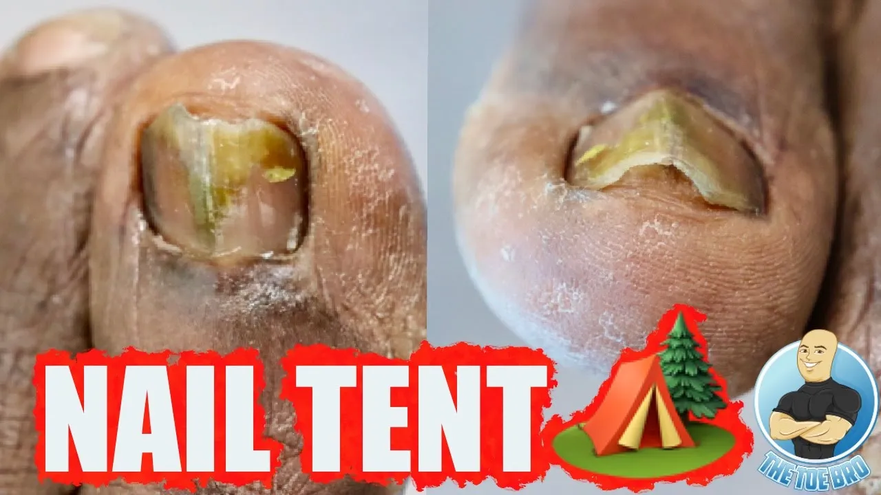 Trimming back a bent & lifted fungal toenail