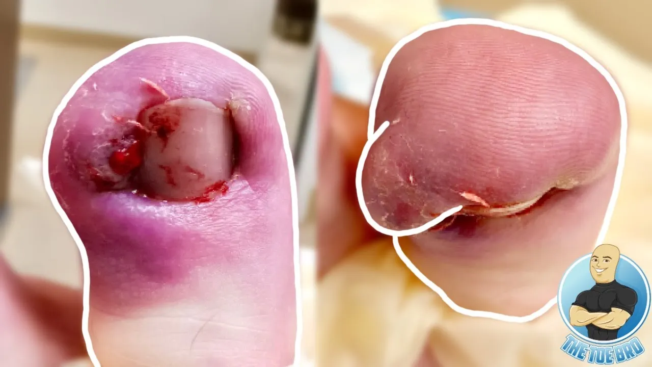 She filmed her ingrown surgery from the hospital and showed me ***graphic video***