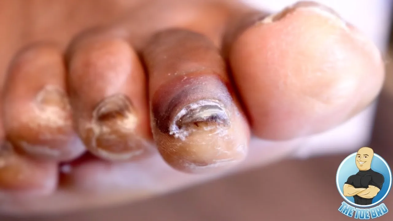 Painful diabetic blood blister gets popped on toe!!!