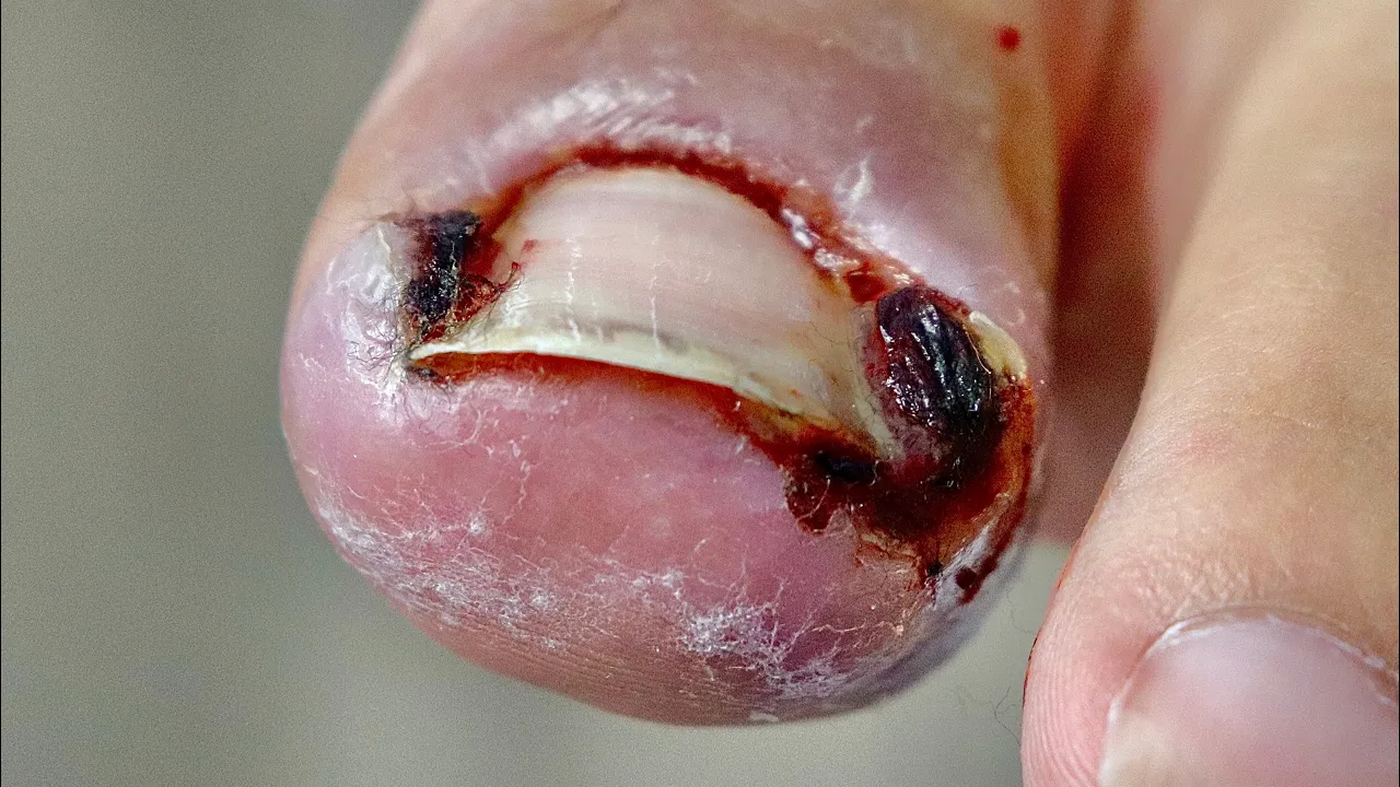 Juicy infected ingrown toenail. you're welcome.