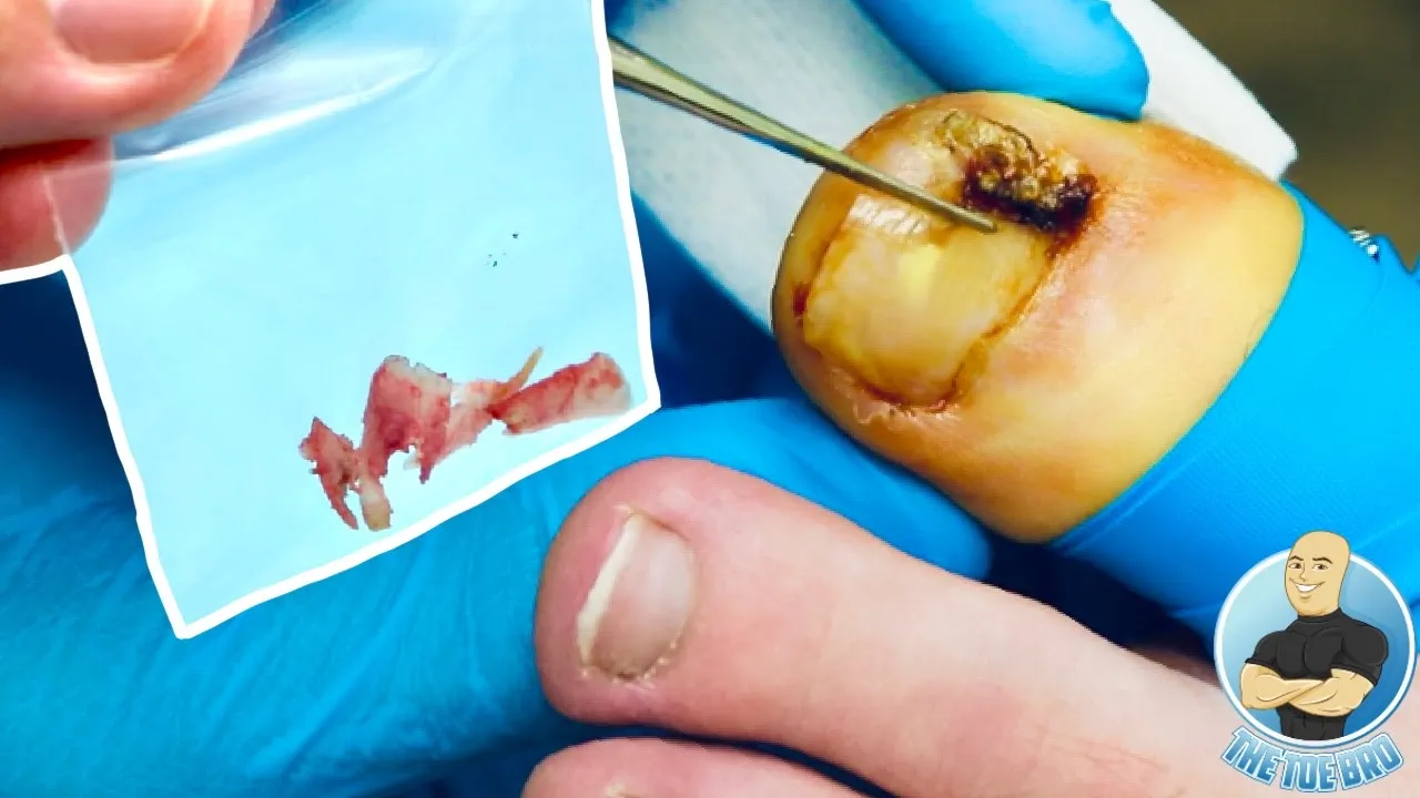 Ingrown toenails so big that he had to take them home as a