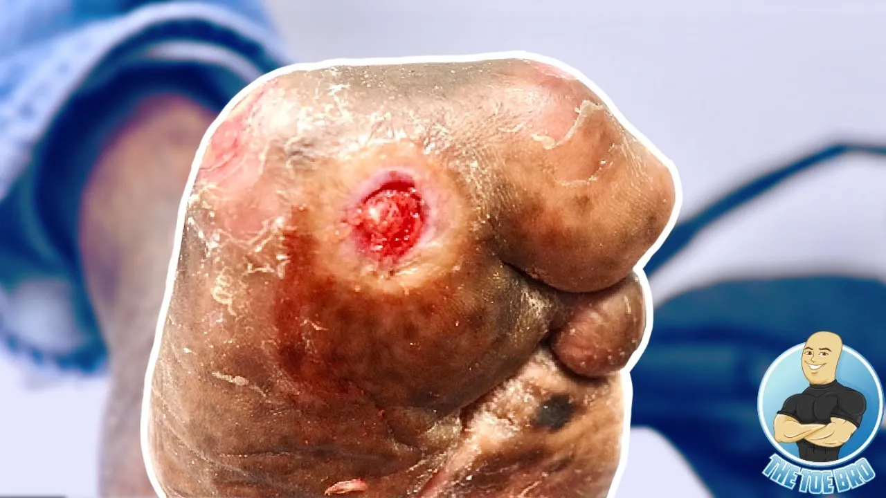 Extreme diabetic callous removal on deformed foot