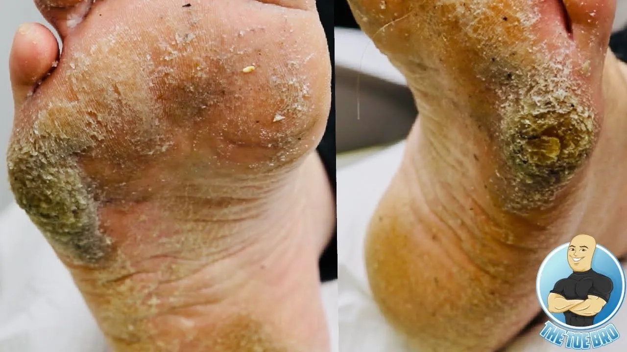 Extra thick hard skin removal treatment ***crazy big callus***