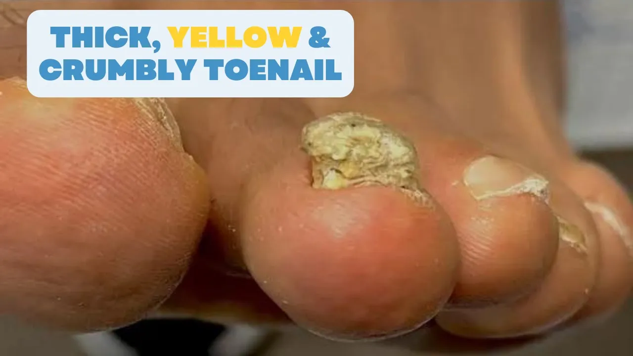 Why Is My Toenail THICK, YELLOW & CRUMBLY!
