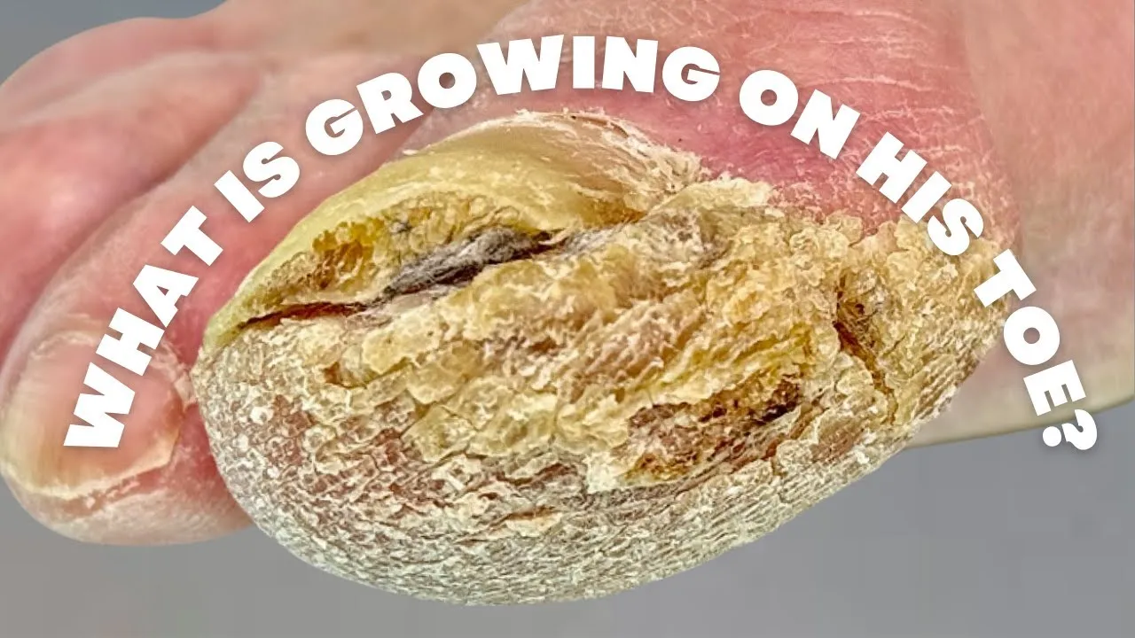 What is GROWING on his TOE!
