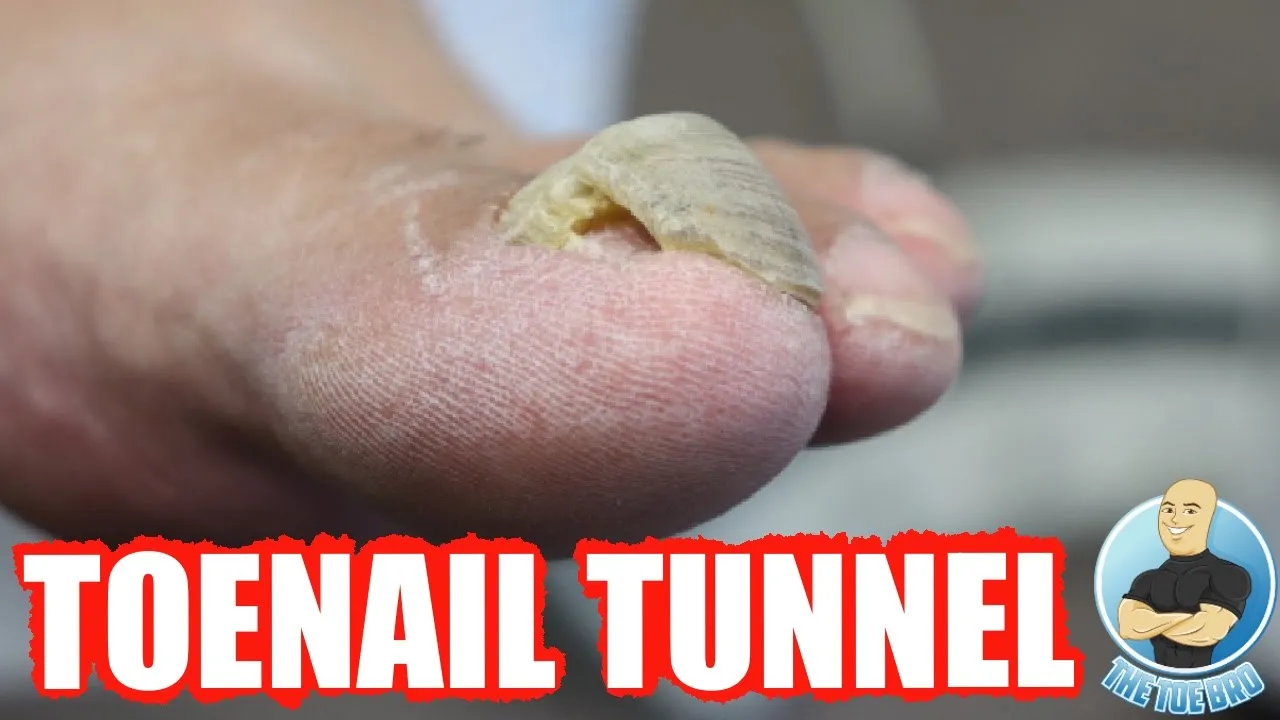Damaged thick toenail has now grown into a toenail tunnel!!!