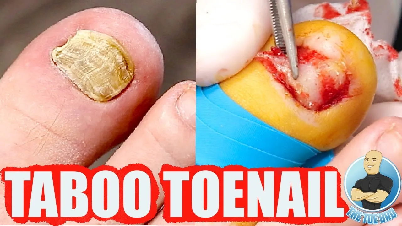 Damaged deformed toenail removed forever!!! ***secret surprise under!!!***