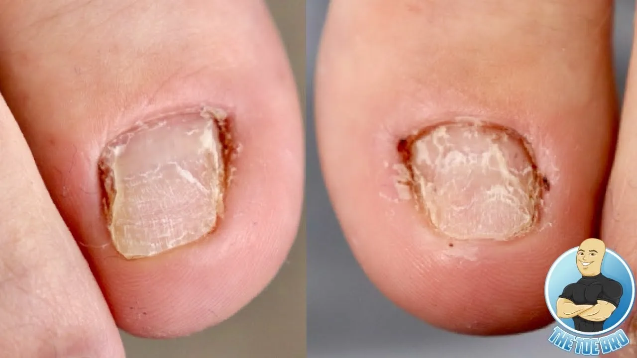 What happens when you pick, rip or pull your toenails for years??? ***damaged toenails treatment***