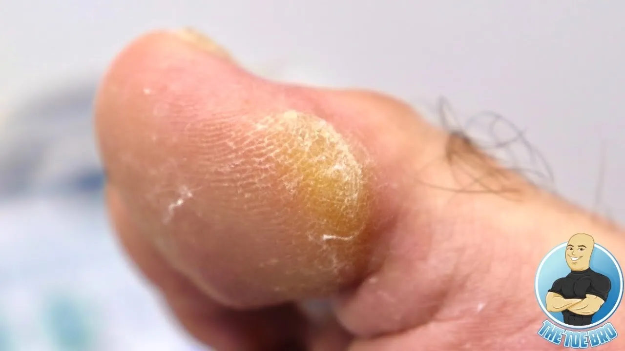 Thick foot callous removal on rasta man ***he made me a toe bro reggae song***