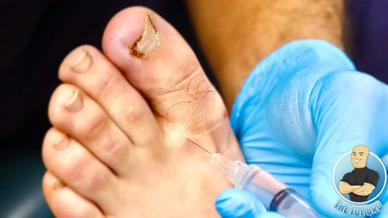 Student performs his first infected ingrown toenail removal ***can he do it?!***