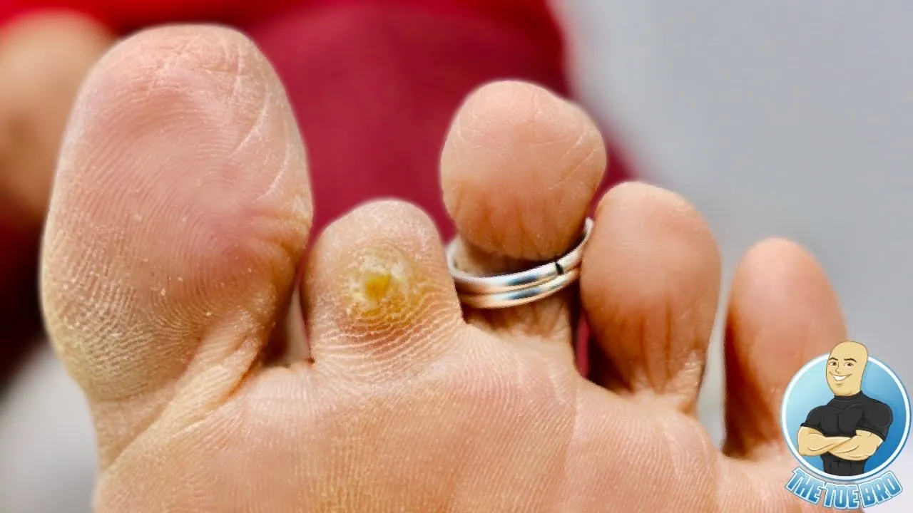 She lost her toe but still getting a painful corn!!! ***unbelievable foot corn***