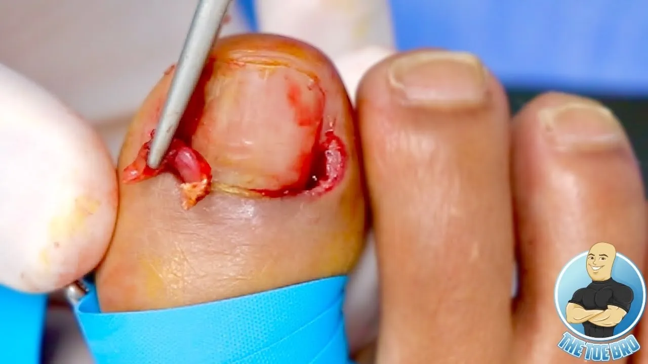 Pulling out her painful chronic ingrown toenails!!! ***satisfying skin pull***