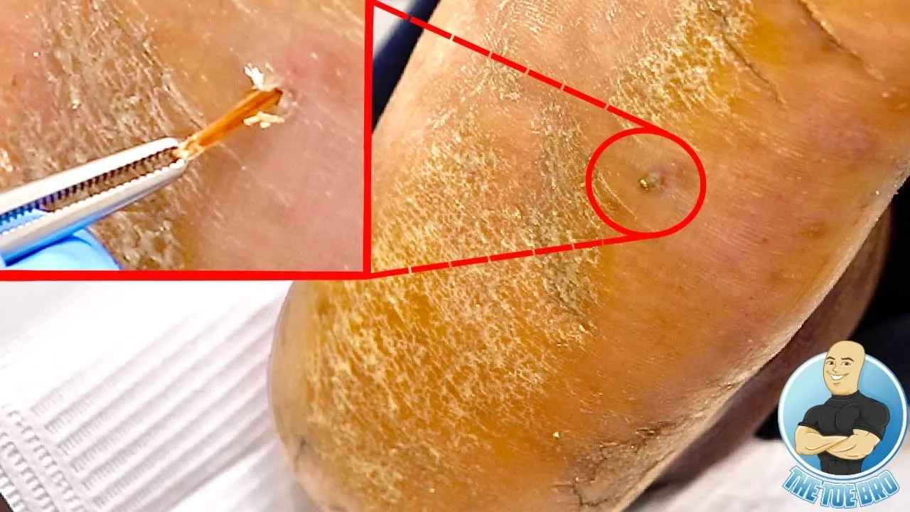 Painful spot on the bottom of her foot ***digging out a foot splinter***