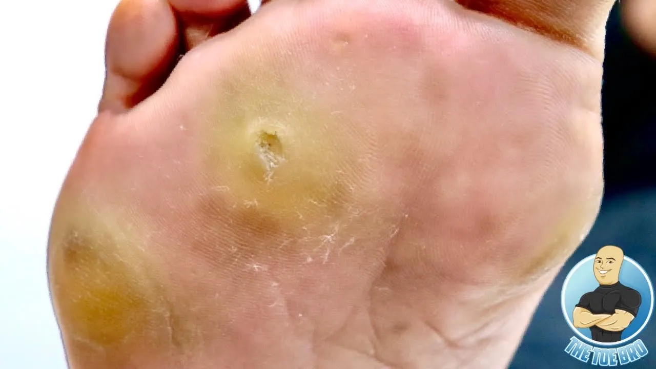 Painful hard skin lesion needs to be surgically removed