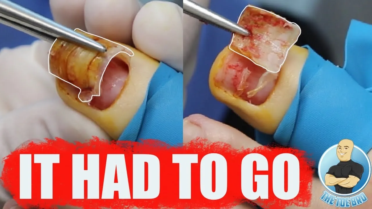 One bad toenail don’t spoil the whole foot girl!!!