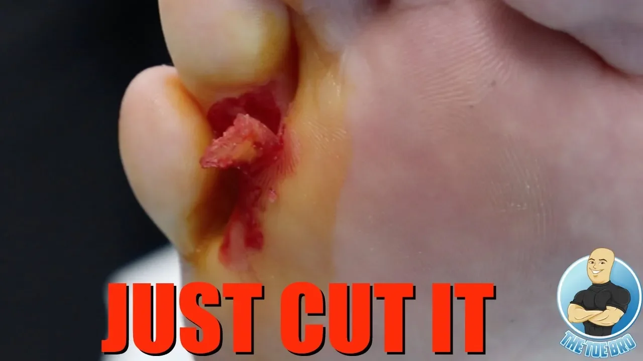 Hard skin growth needs to be cut out ***what is it?!***