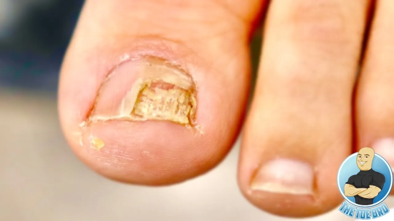 Damaged toenail not growing attached ***is it nail fungus???***