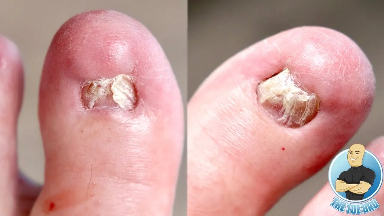 Damaged and deformed big toenails after failed nail surgeries ***removing them forever***