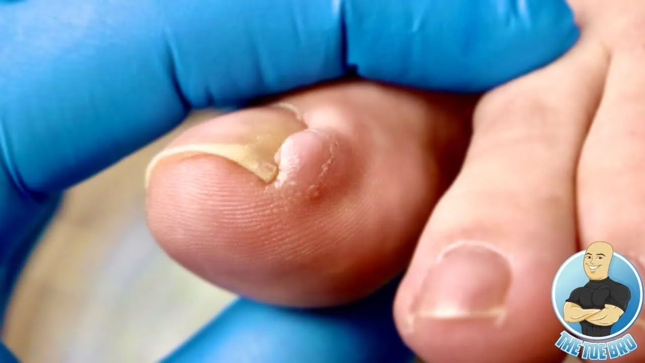 Busting down her ***ingrown*** side walls!!! overgrown toenail removal!!!