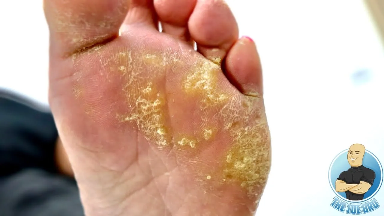 Abnormal crazy callous only on one foot!!! ***dead skin scraping***