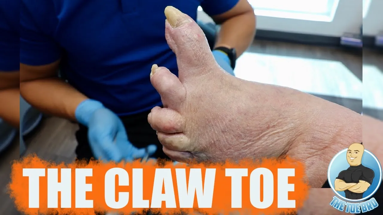 Toenail nail clipping on an extremely abnormal foot
