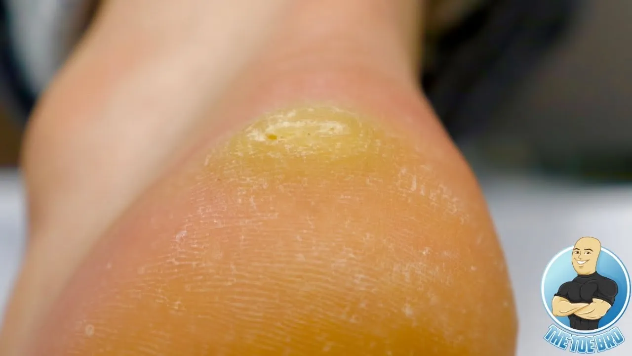Thick heel callous removal ***satisfying hard skin scraping***