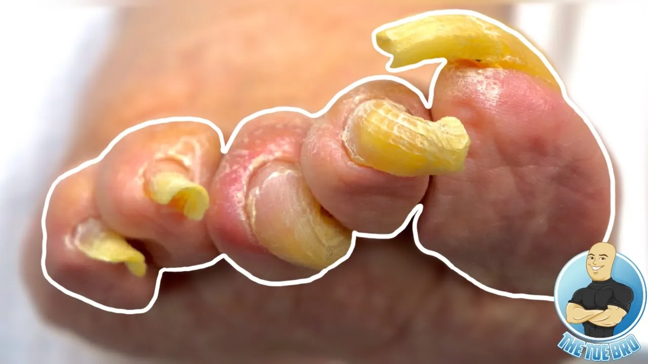 She hasn’t cut her toenails in years ***long toenail trimming***