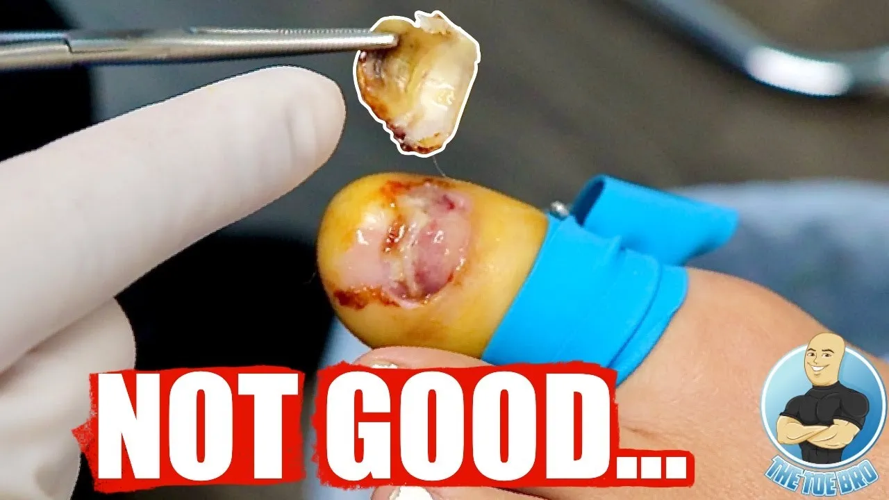 She didn't want me to remove her toenail...but i had to!!!