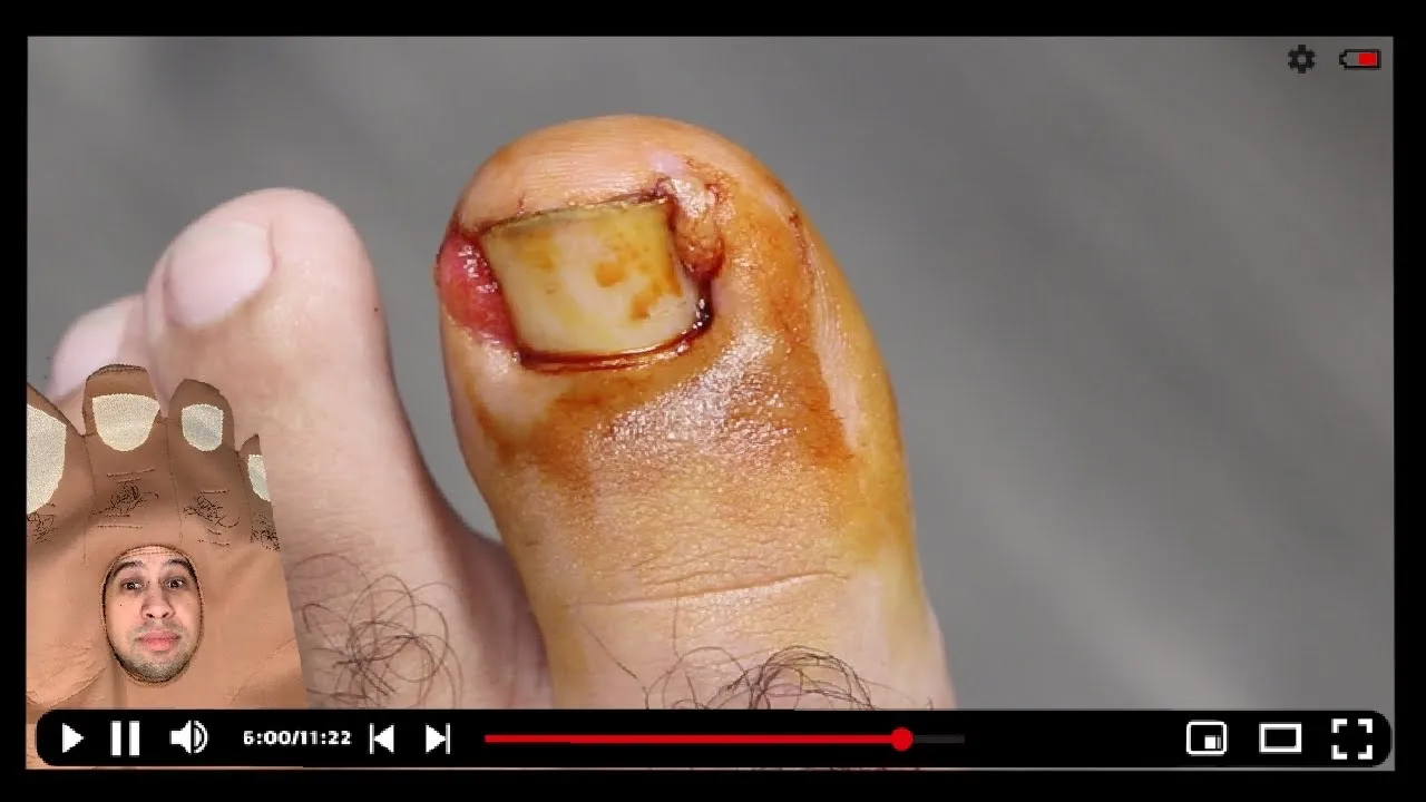 Ingrown nail + bumpy skin removal