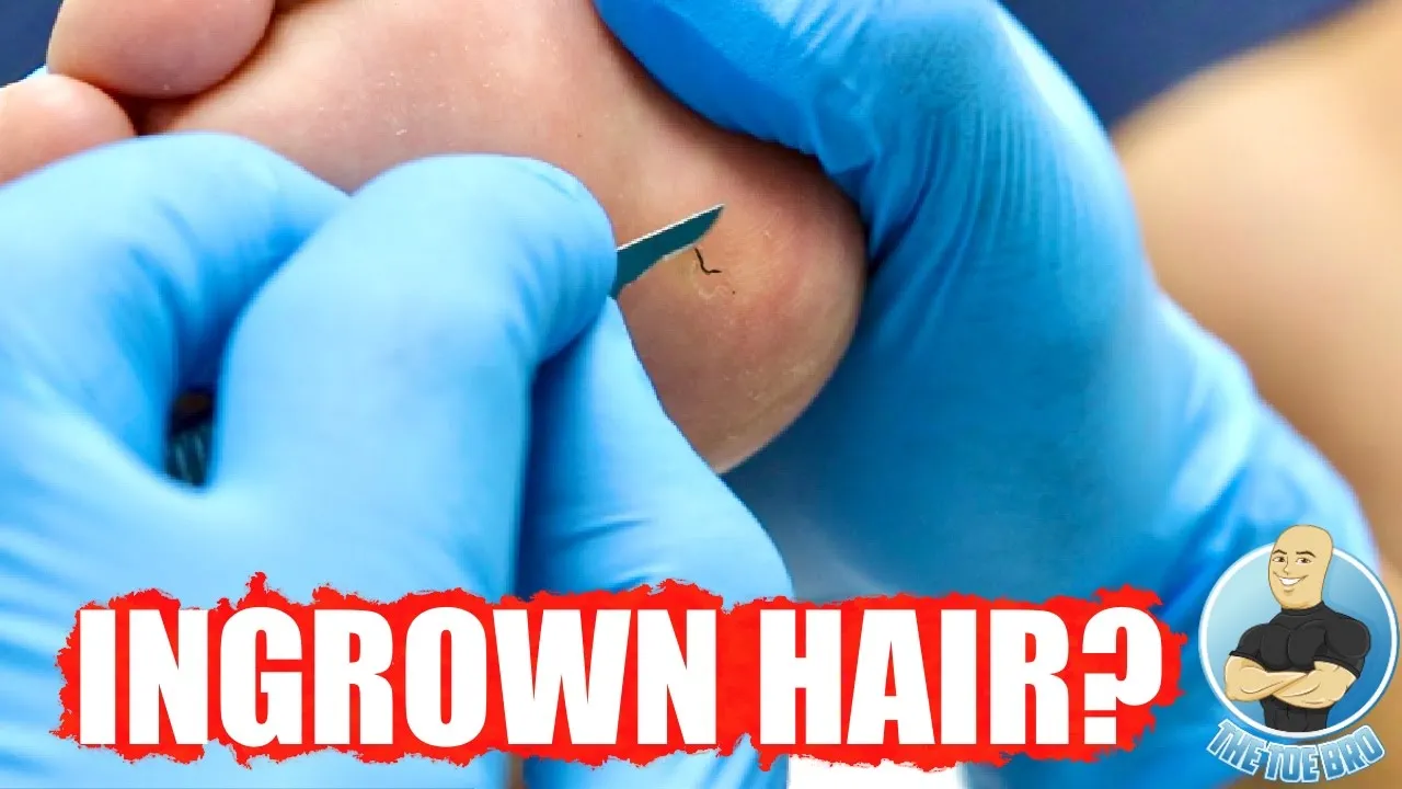 Ingrown hair growing out of her foot?!
