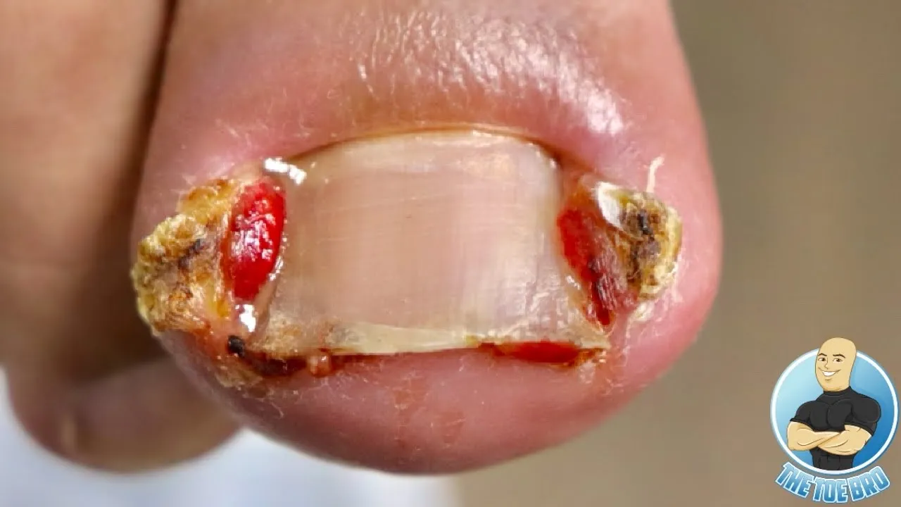 What happens when you don’t treat an ingrown toenail??? ***warning: very graphic***